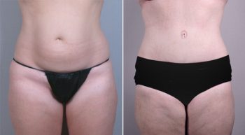 Breast Lift with Implants Patient 8