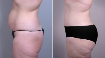 Breast Lift with Implants Patient 8