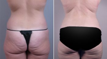 Breast Lift with Implants Patient 8