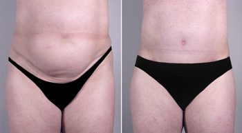 Removal & Replacement of Implants Patient 10