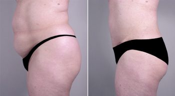 Removal & Replacement of Implants Patient 10