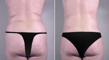 Removal & Replacement of Implants Patient 10