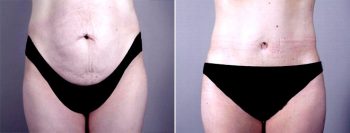 Breast Lift with Implants Patient 9