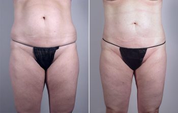 Breast Lift with Implants Patient 10