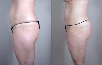 Breast Lift with Implants Patient 10