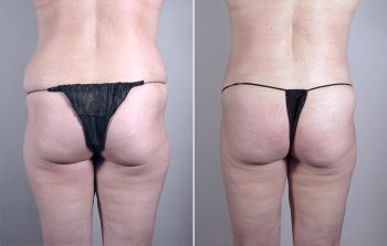 Breast Lift with Implants Patient 10