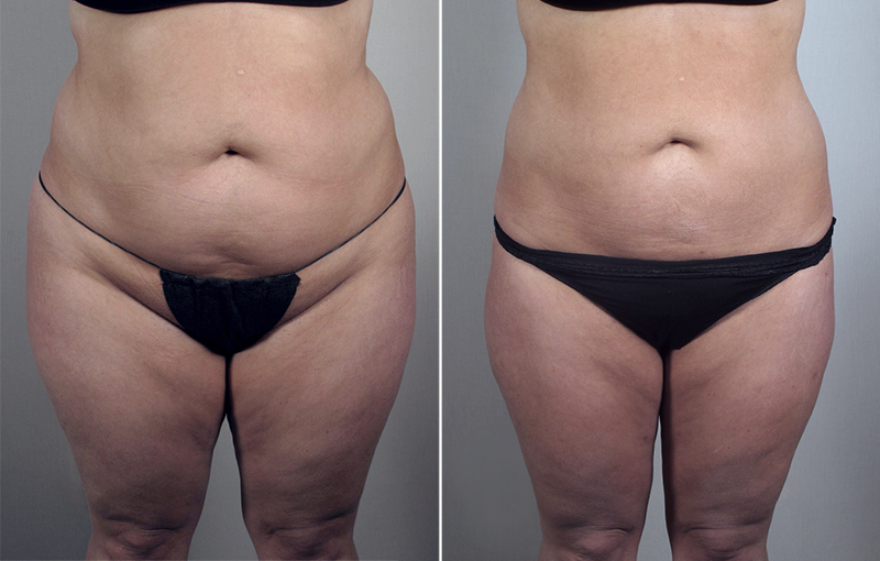 Liposuction Patient 31