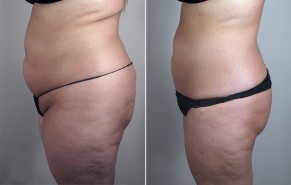 New Jersey Liposuction Photos
