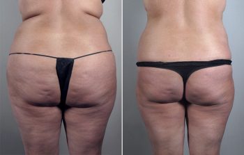 Liposuction Patient 31