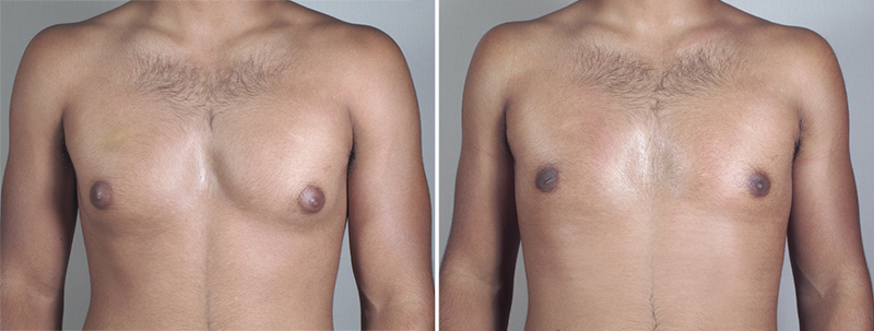 Gynecomastia Reduction Patient 28