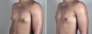 Gynecomastia Reduction Patient 28