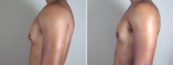 Gynecomastia Reduction Patient 28