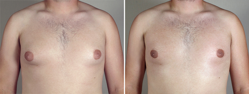 Gynecomastia Reduction Patient 29