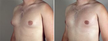Gynecomastia Reduction Patient 29