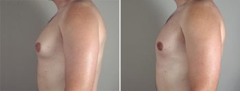 Gynecomastia Reduction Patient 29