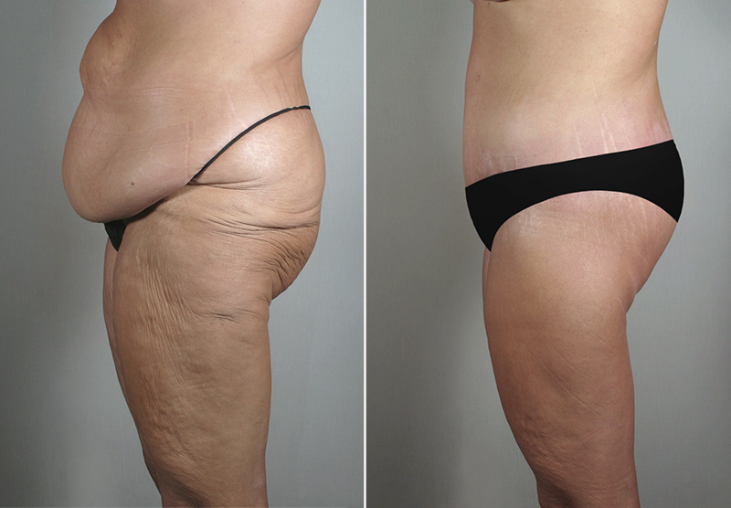 Body Lift Patient Photo
