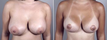 Breast Lift with Implants Patient 2