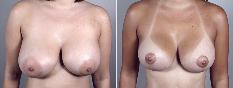 Breast Lift with Implants Patient 2