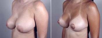 Breast Lift with Implants Patient 2