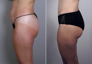 Breast Lift with Implants Patient 2