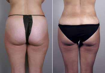 Breast Lift with Implants Patient 2