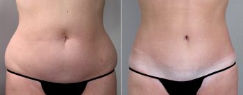 Breast Lift (Vertical Mastopexy Only) Patient 5