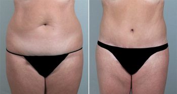 Breast Lift (Vertical Mastopexy Only) Patient 4