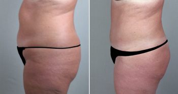 Breast Lift (Vertical Mastopexy Only) Patient 4