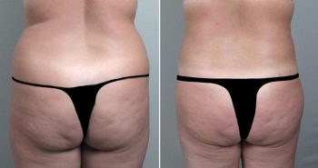 Breast Lift (Vertical Mastopexy Only) Patient 4