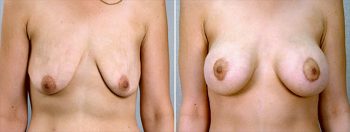 Breast Lift with Implants Patient 12