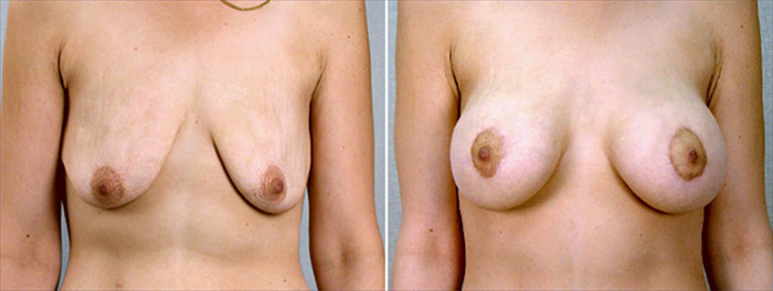 Breast Lift with Implants Patient 12
