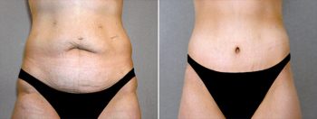 Breast Lift with Implants Patient 12