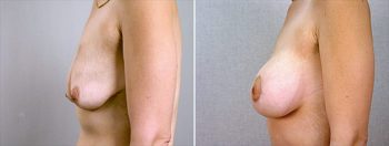 Breast Lift with Implants Patient 12