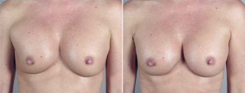 Removal & Replacement of Implants Patient 8