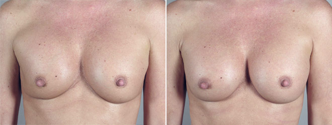 Removal & Replacement of Implants Patient 8