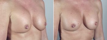Removal & Replacement of Implants Patient 8