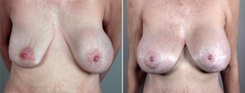 Removal & Replacement of Implants Patient 13