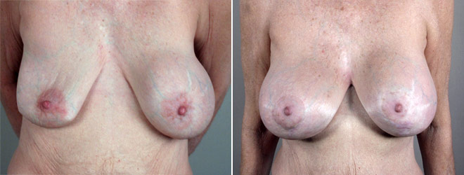 Removal & Replacement of Implants Patient 13