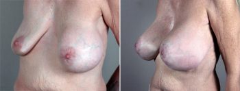 Removal & Replacement of Implants Patient 13