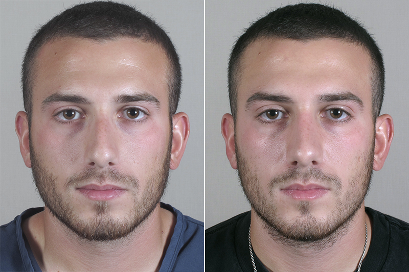 Male Rhinoplasty Patient 13
