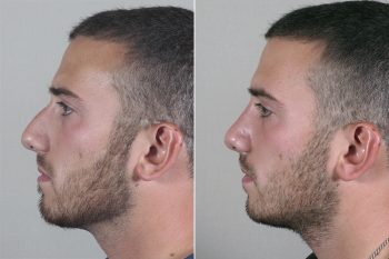 Male Rhinoplasty Patient 13