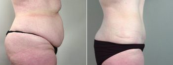 Breast Lift (Vertical Mastopexy Only) Patient 6