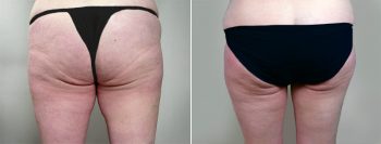 Breast Lift (Vertical Mastopexy Only) Patient 6