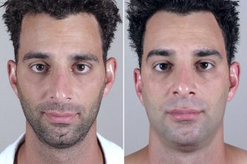 Male Chin Enlargement Patient 4