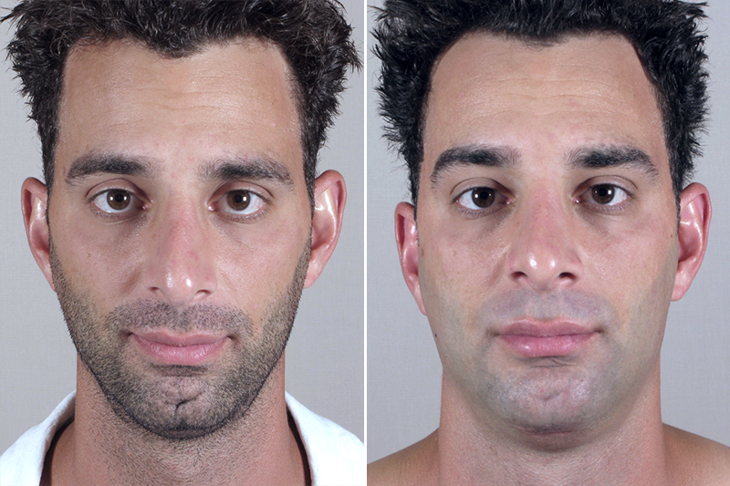 Male Chin Enlargement Patient 4