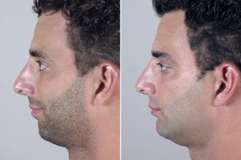 Male Chin Enlargement Patient 4
