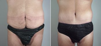 Male Abdominoplasty Patient 7
