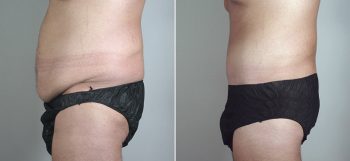 Male Abdominoplasty Patient 7