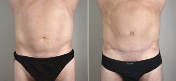 Male Abdominoplasty Patient 6