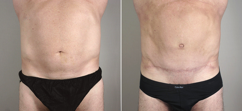 Male Abdominoplasty Patient 6